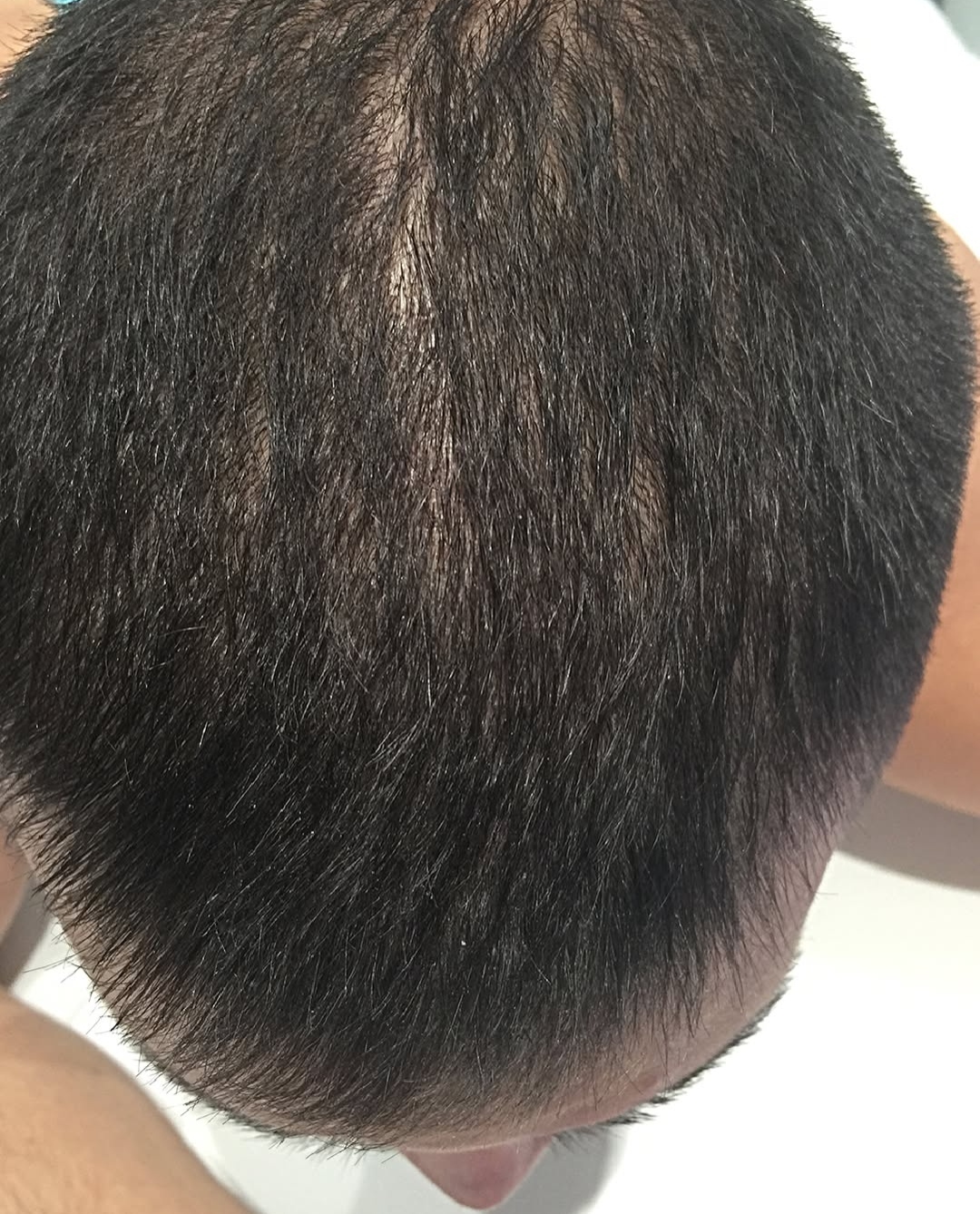 Dopo F-HAIR MEN laterale