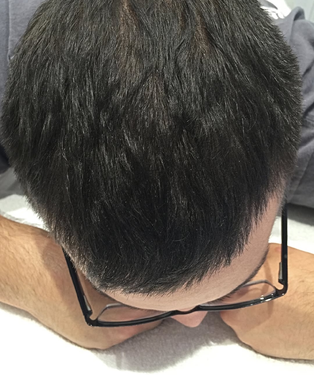 Dopo F-HAIR MEN densità